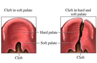 cleft palate speech therapy 