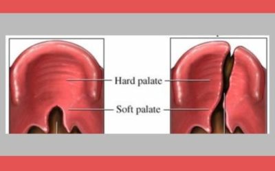 Cleft Palate Speech Therapy Techniques: CLP Team Tips