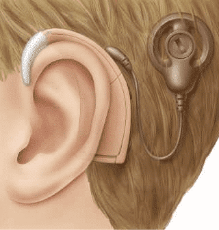 Cochlear Implants &ndash; General Information